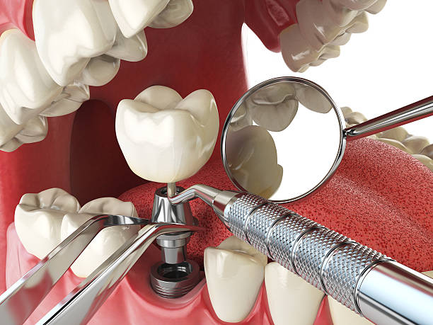 Best Lost Filling or Crown Replacement in Jellico, TN